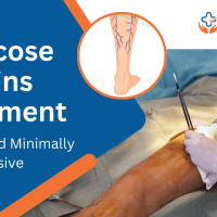 Varicose Veins treatment in Vizag