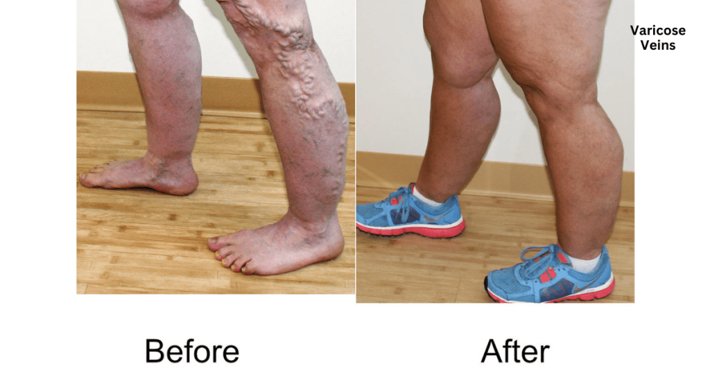 varicose veins treatment in vizag