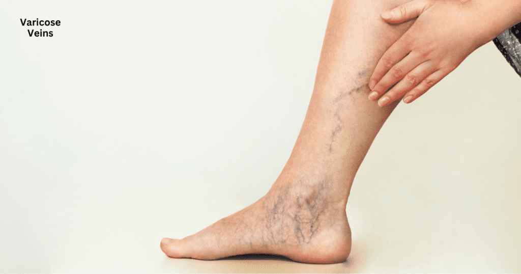 varicose veins treatment in vizag