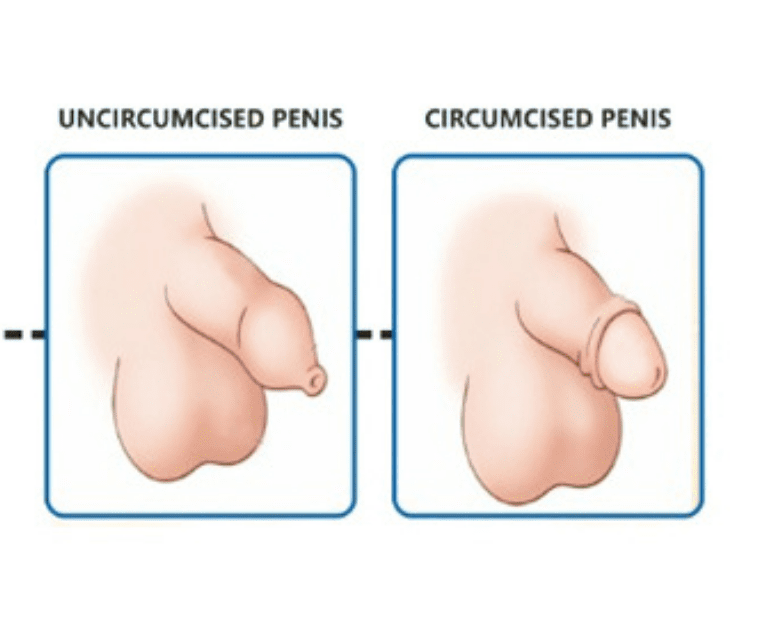 circumcision surgery in Vizag