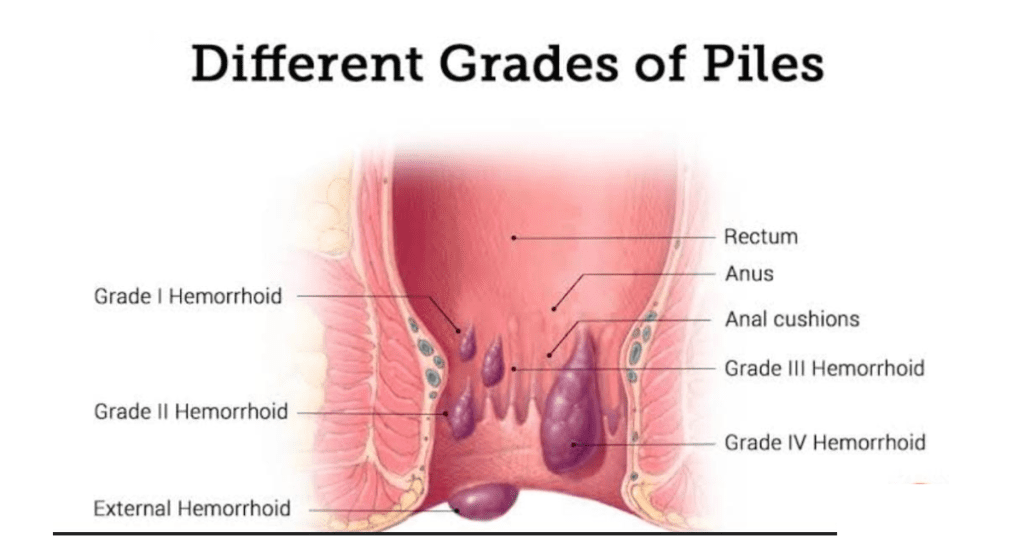 Piles laser treatment in vizag