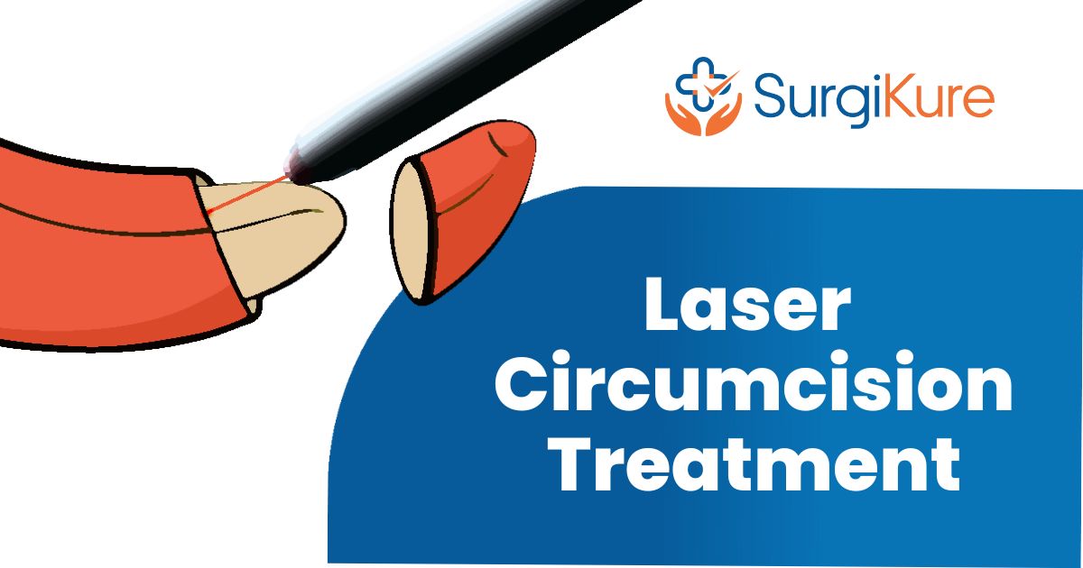 Laser Circumcision Treatment – Quick, Safe, and Effective at Surgikure