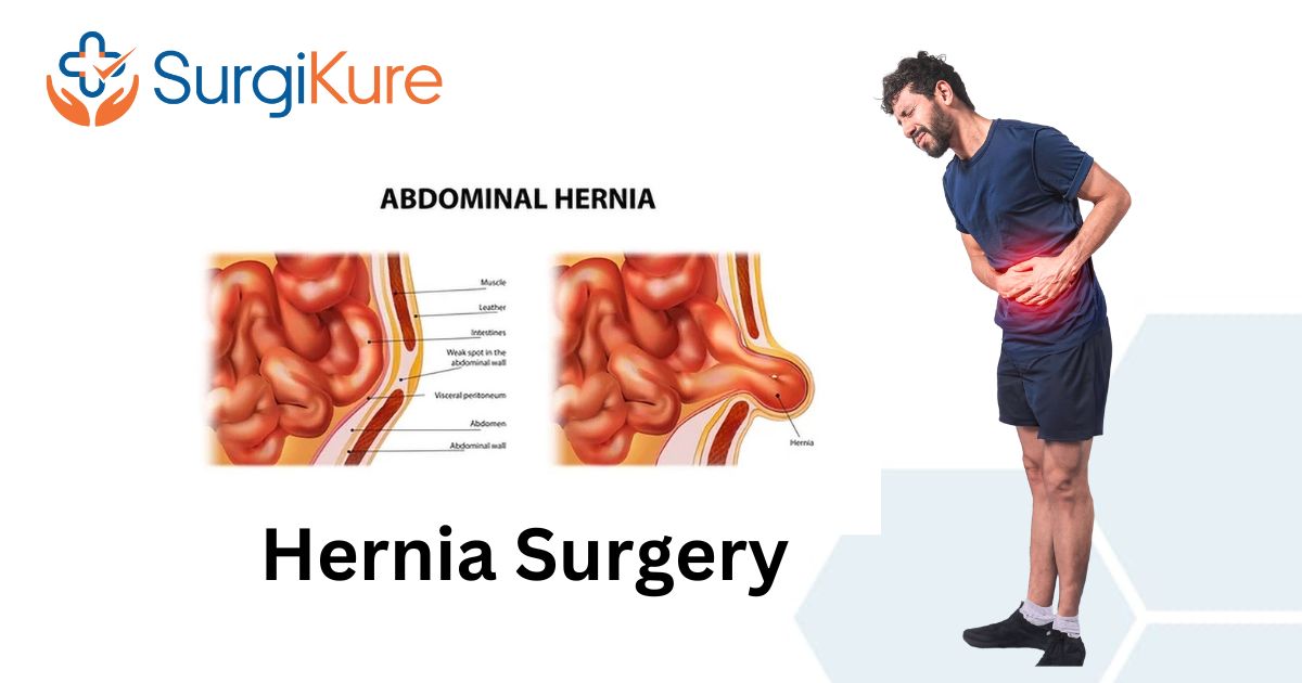 comprehensive Hernia Surgery in Vizag and Vijayawada: Advanced Care at Surgikure