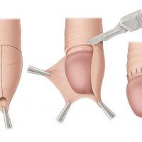 stapler circumcision in hyderabad