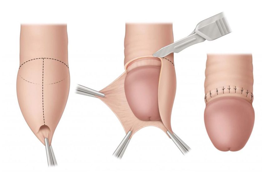 stapler circumcision in Vijayawada stapler circumcision in Vijayawada