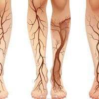 varicose veins treatment