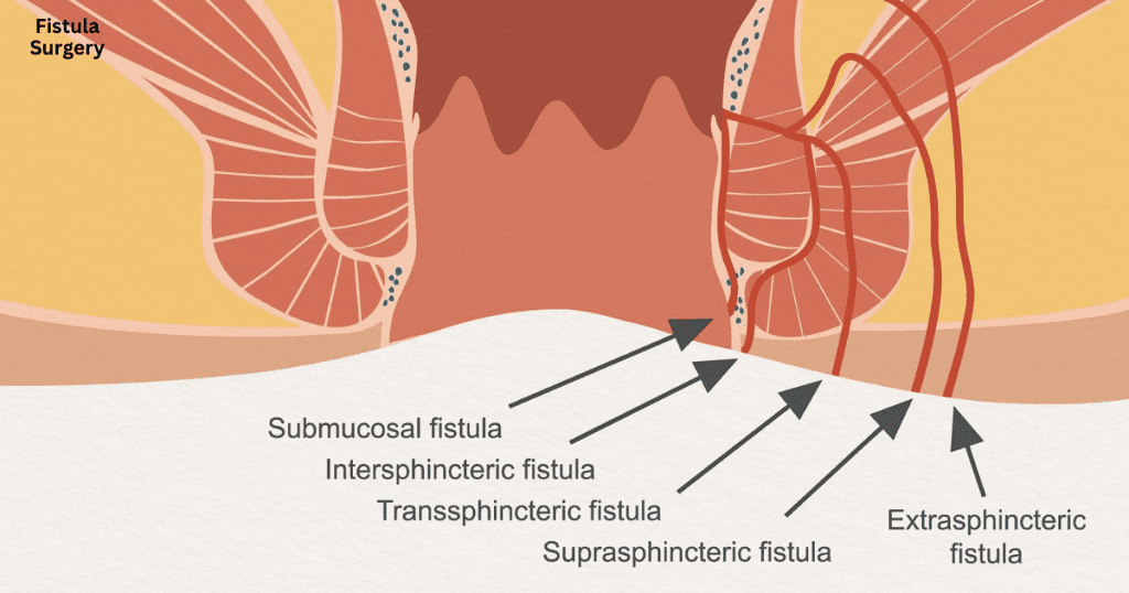 Fistula Surgery in Vizag