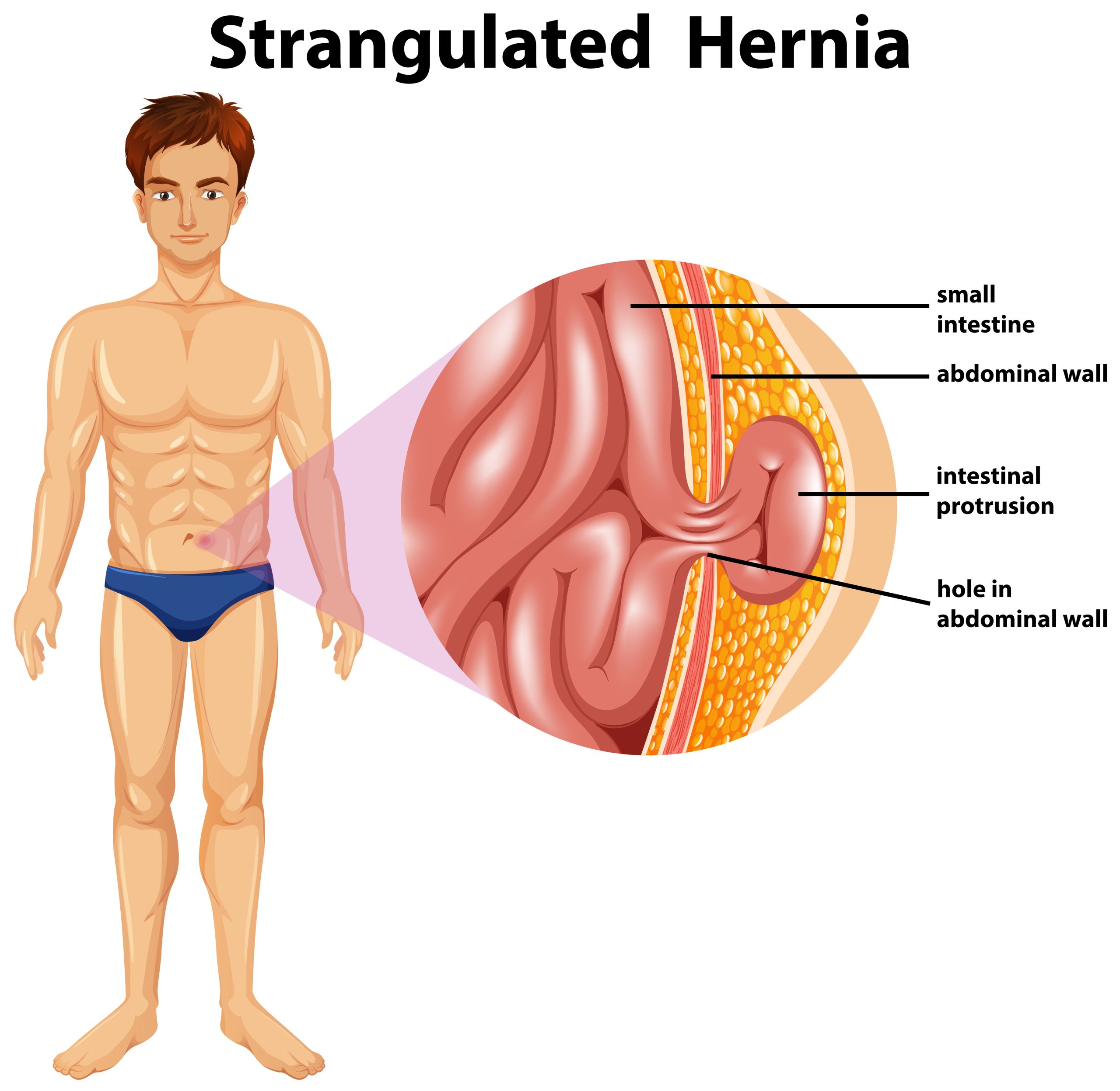 Hernia Treatment in vijayawada