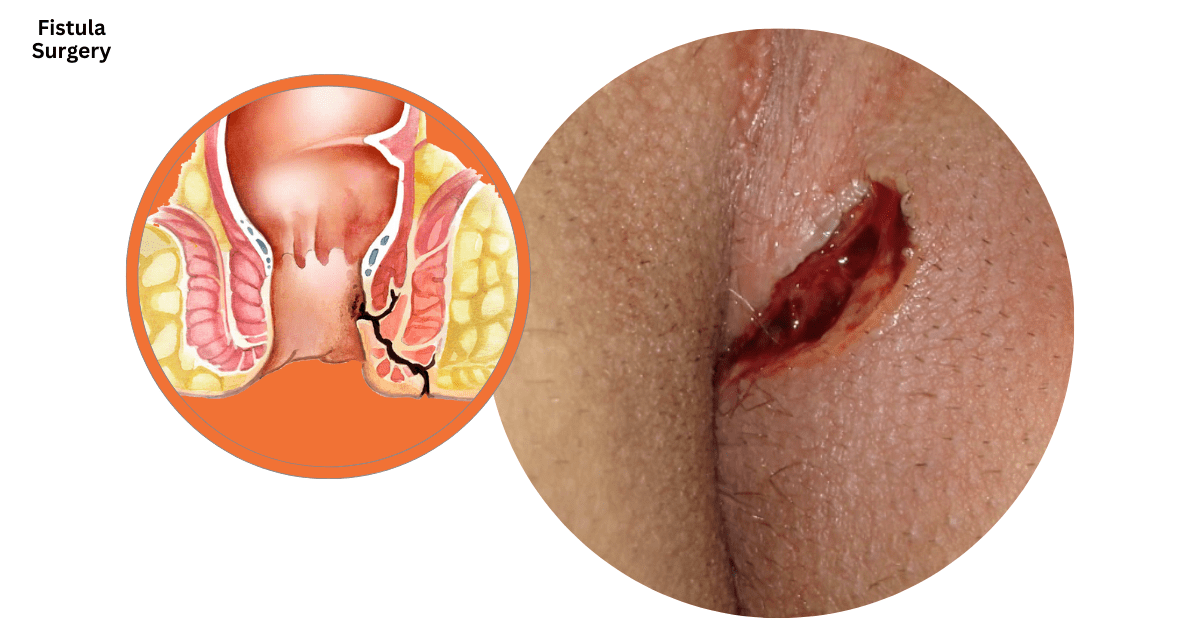 laser fistula treatment in Hyderabad