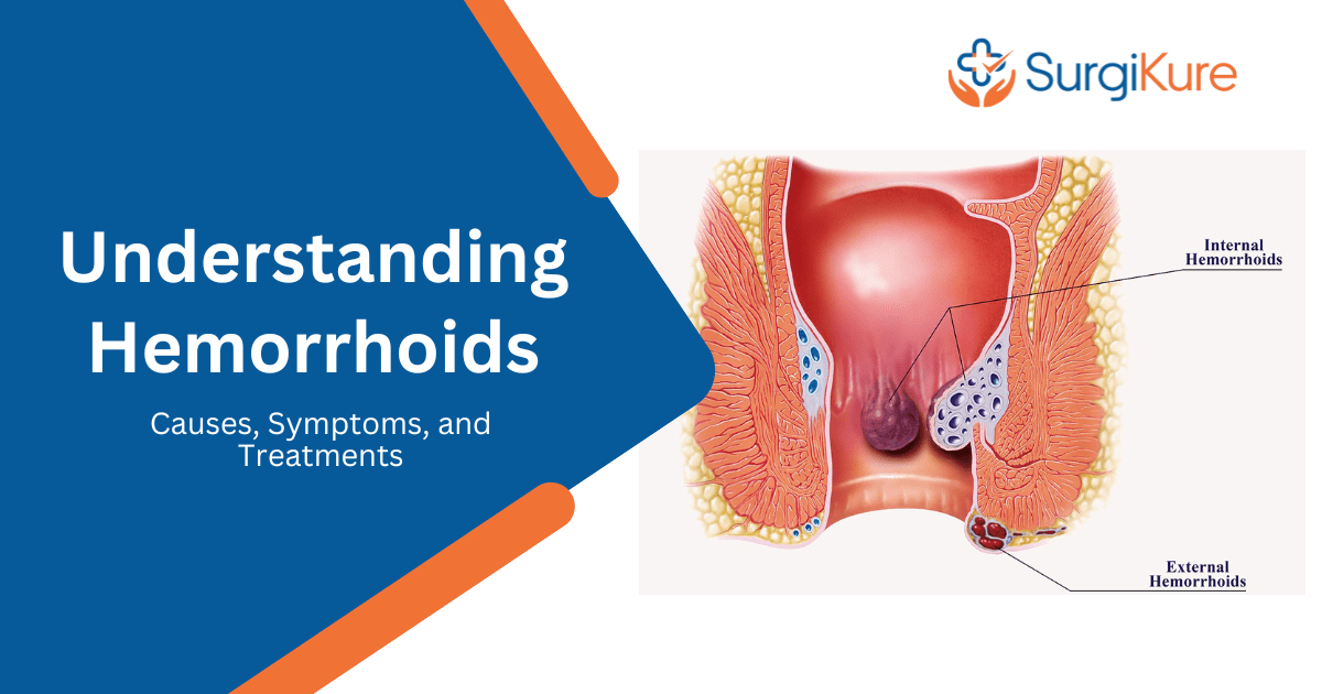 Guide to Understanding Hemorrhoids Treatment, Causes and Symptoms