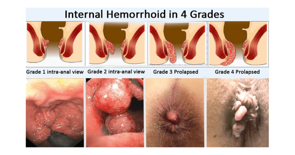 Hemorrhoids Treatment in Vizag