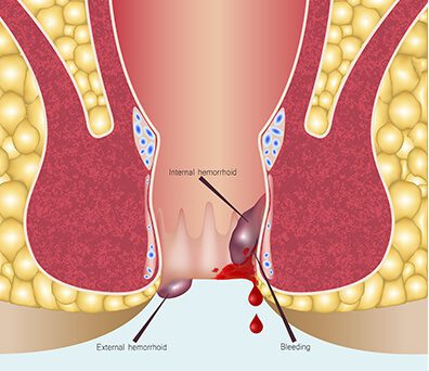 fissure