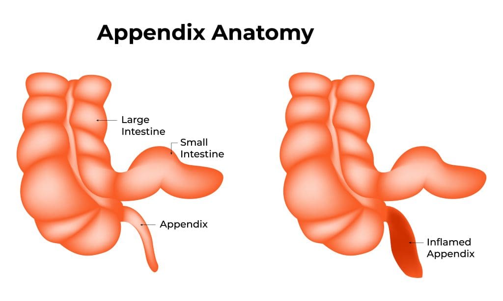 Appendicitis Treatment in Vizag