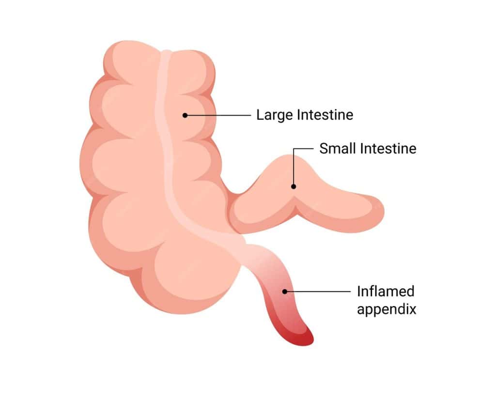 Appendicitis Treatment in Vizag