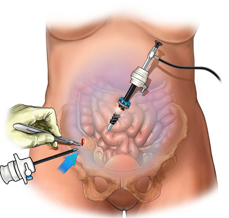 Laparoscopy Treatment in Vizag: A Minimally Invasive Solution for multiple health conditions