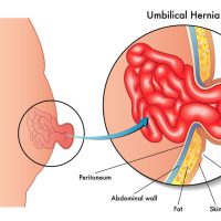 Hernia specialist