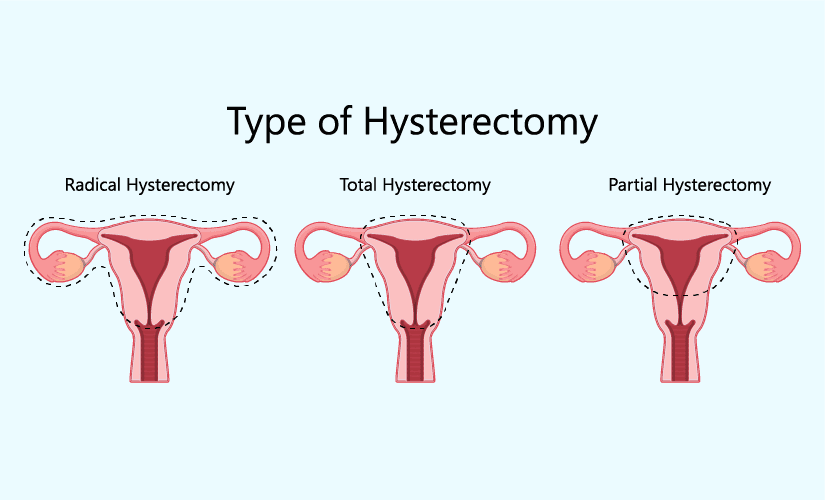 Hysterectomy treatment in vizag