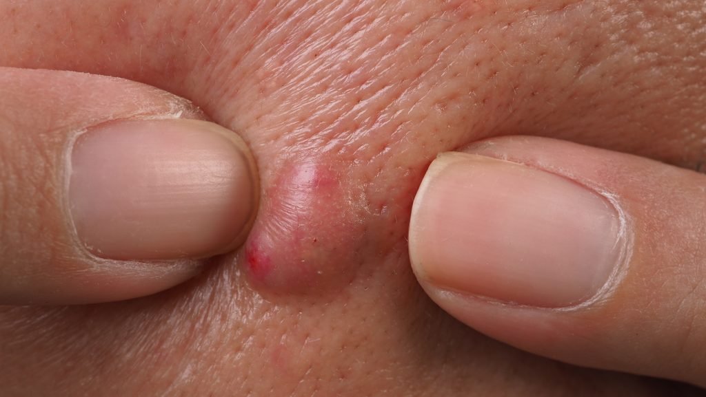 Your Guide to Laser Abscess Treatment in Vizag: Causes, Diagnosis, and ...