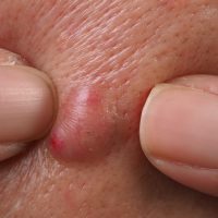 Abscess Treatment in Vizag