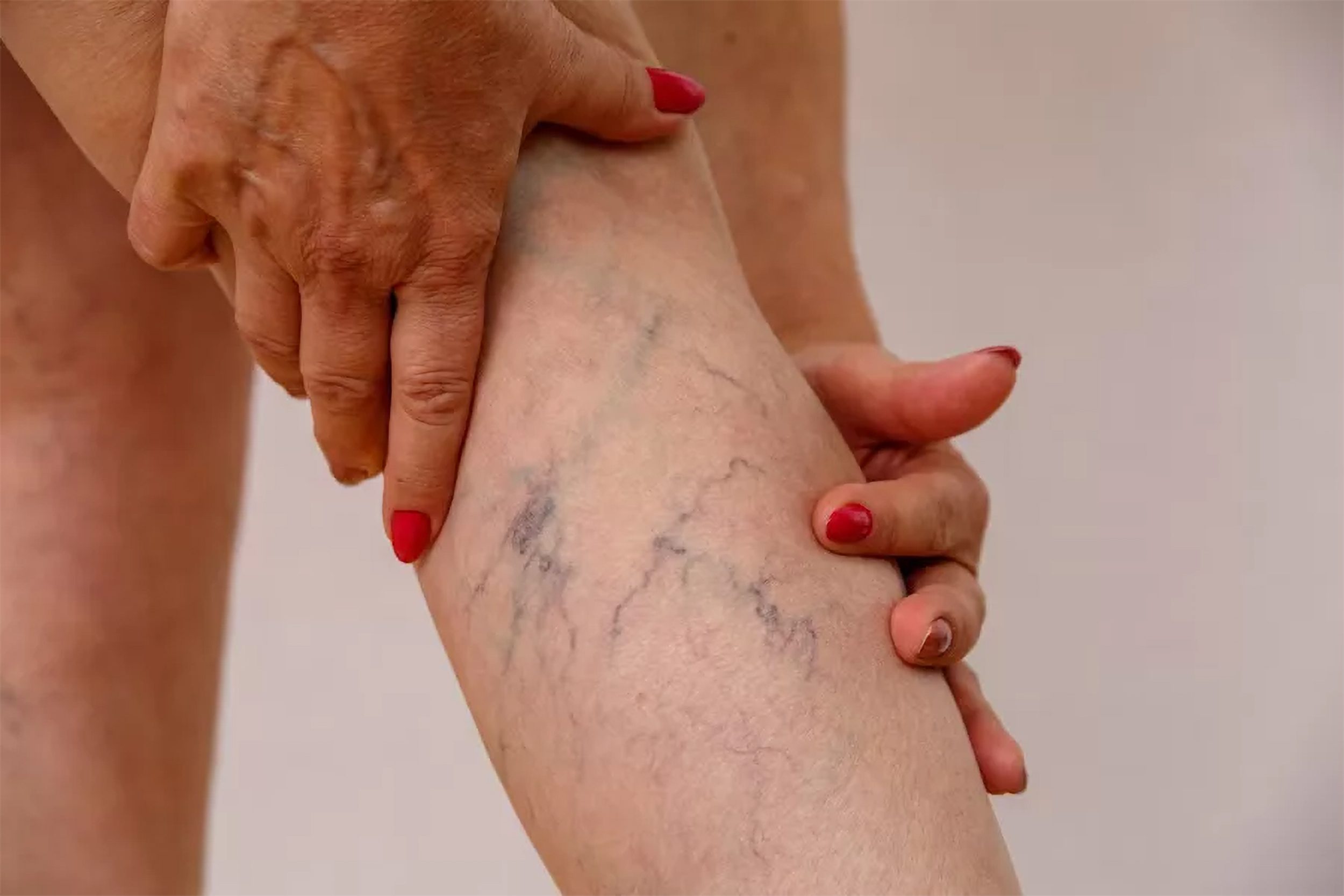 How to Prevent and Treat Deep Vein Thrombosis Effectively