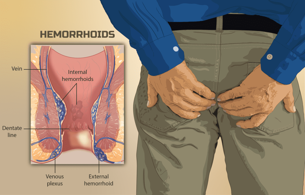 Hemorrhoids Meaning