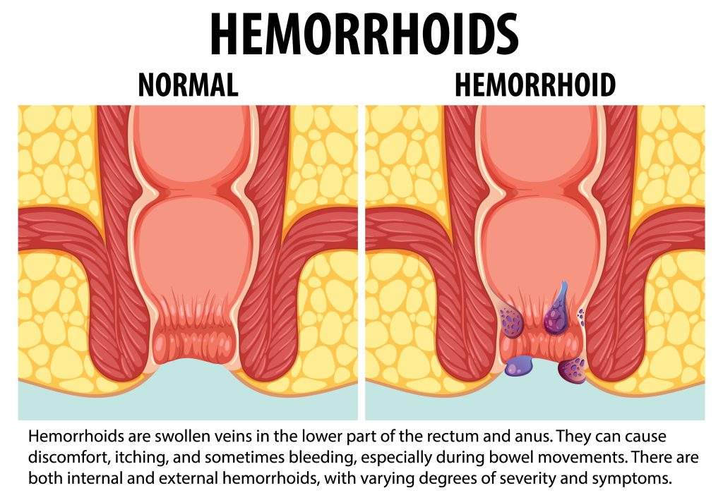 Hemorrhoids Meaning
