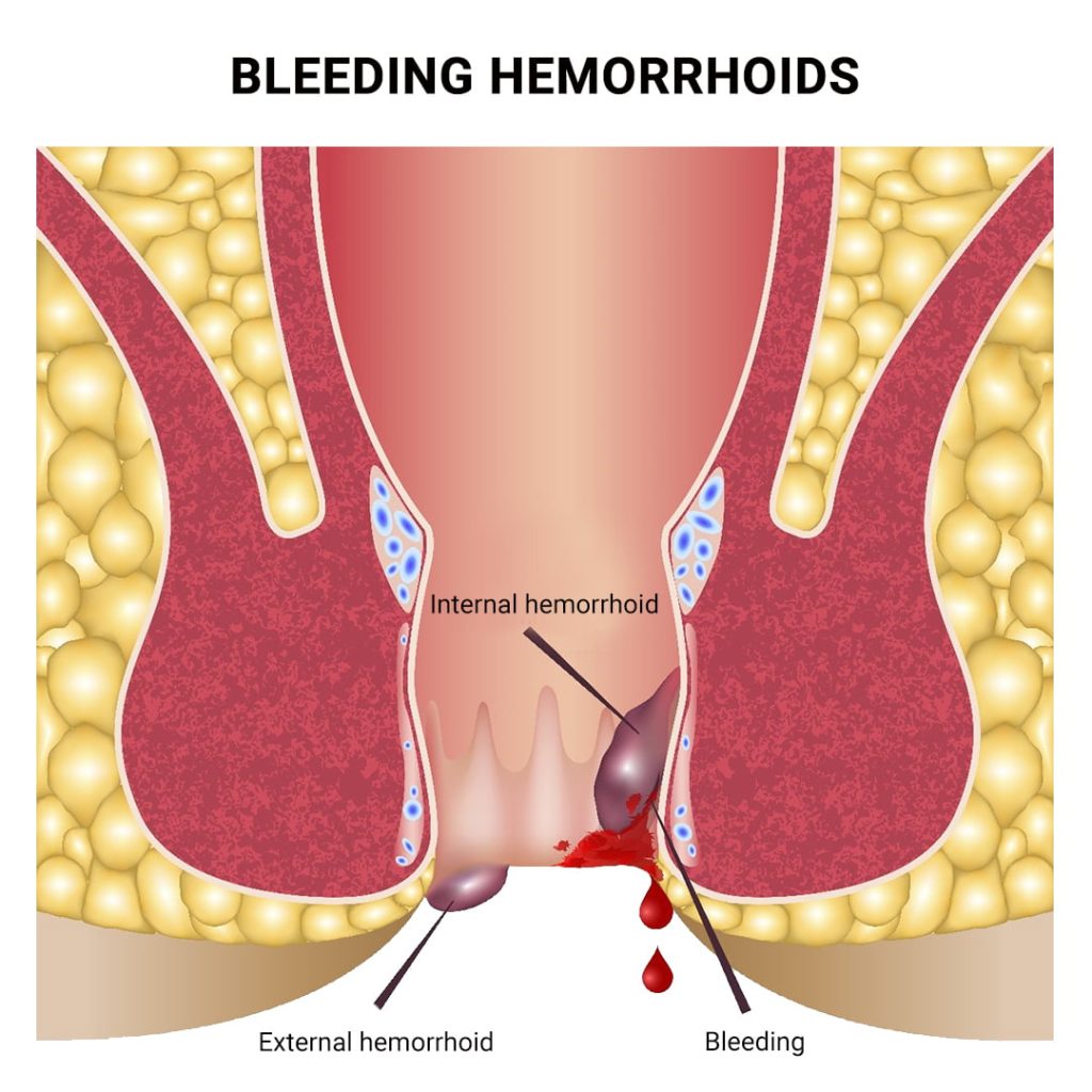 bleeding from the anus