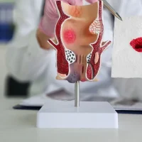 Bleeding from the Anus