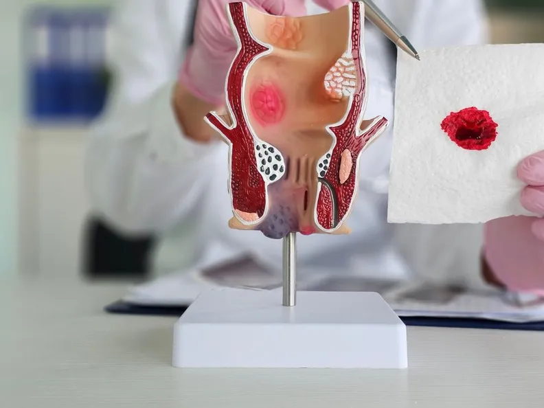 Understanding the Causes of Bleeding from the Anus: An Informative Guide