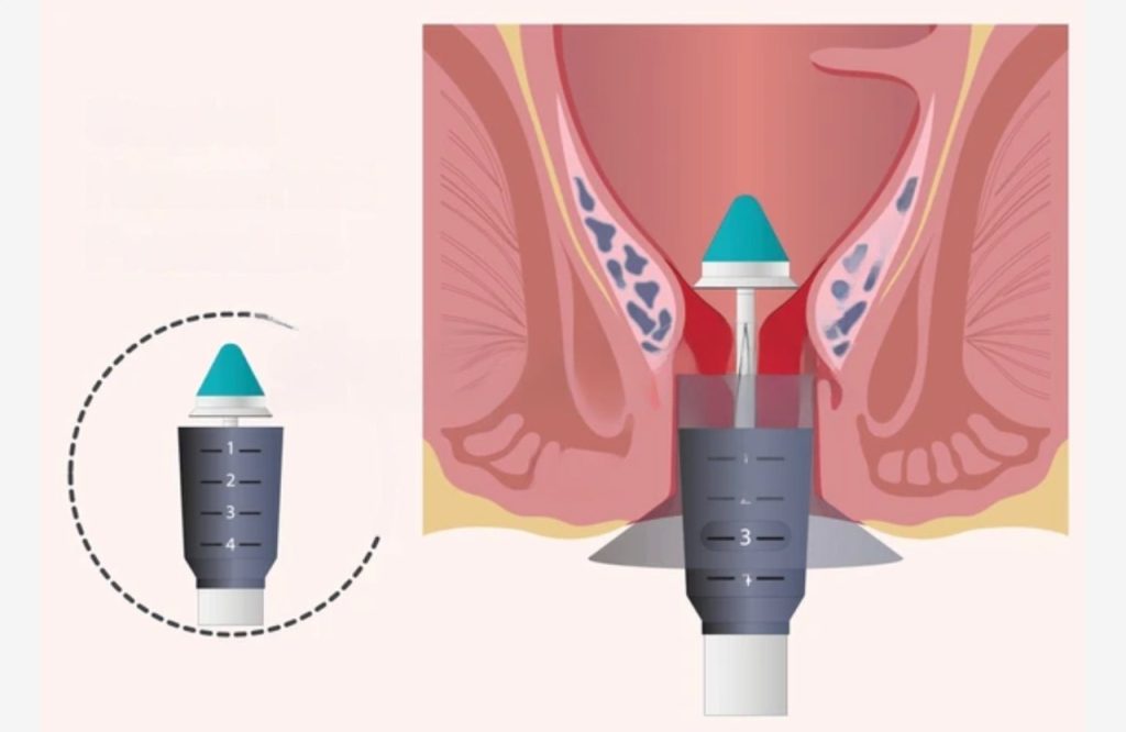 Stapled Hemorrhoidectomy