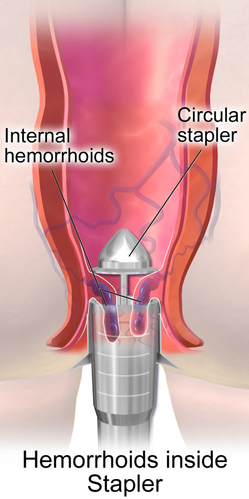 Stapled Hemorrhoidectomy