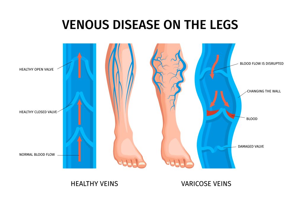 Varicose Veins Treatment