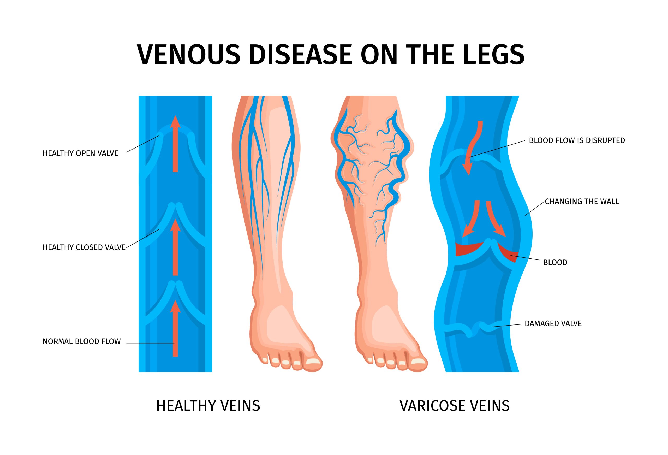 Varicose Veins Treatment