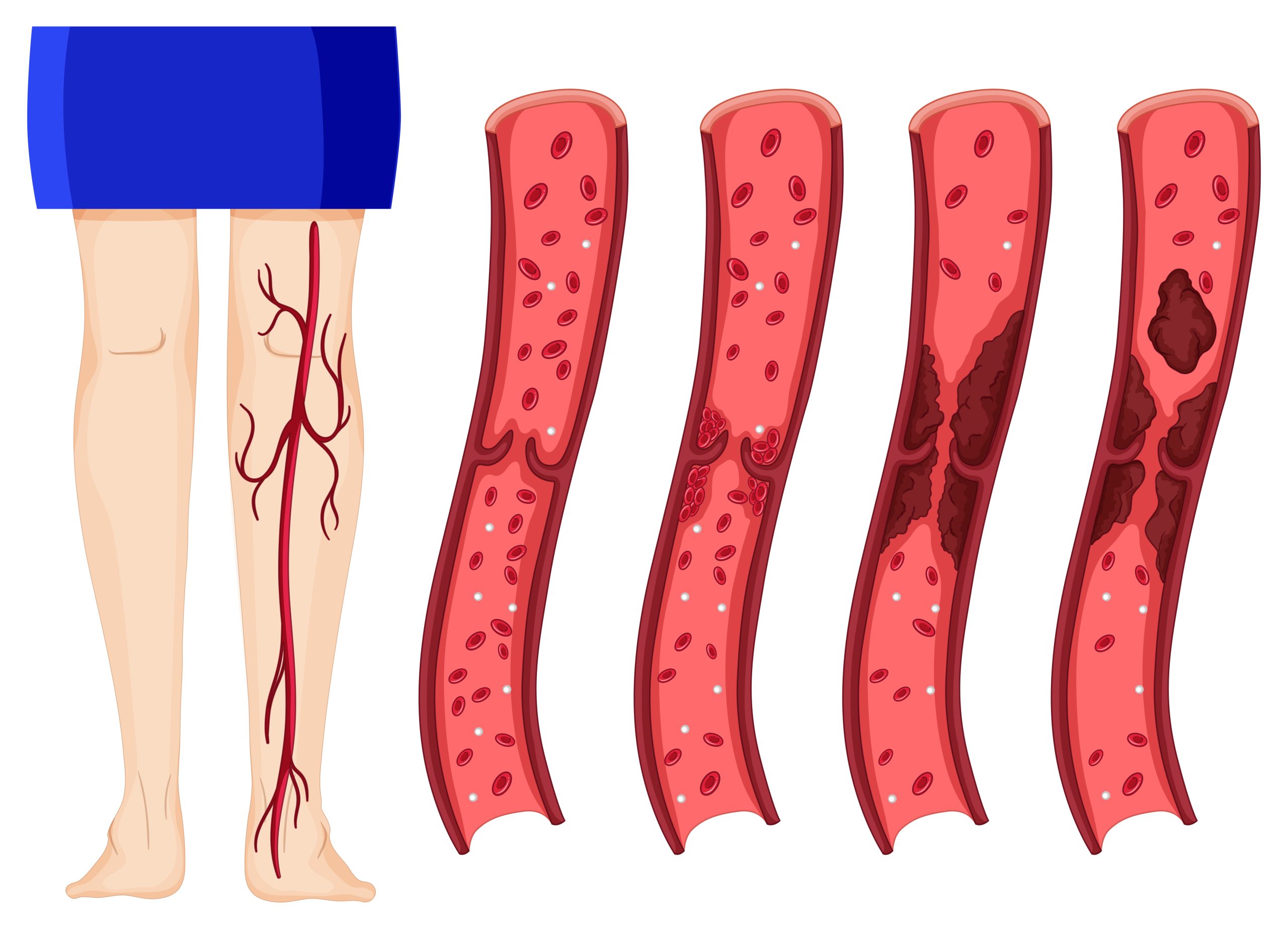 Varicose Veins Treatment