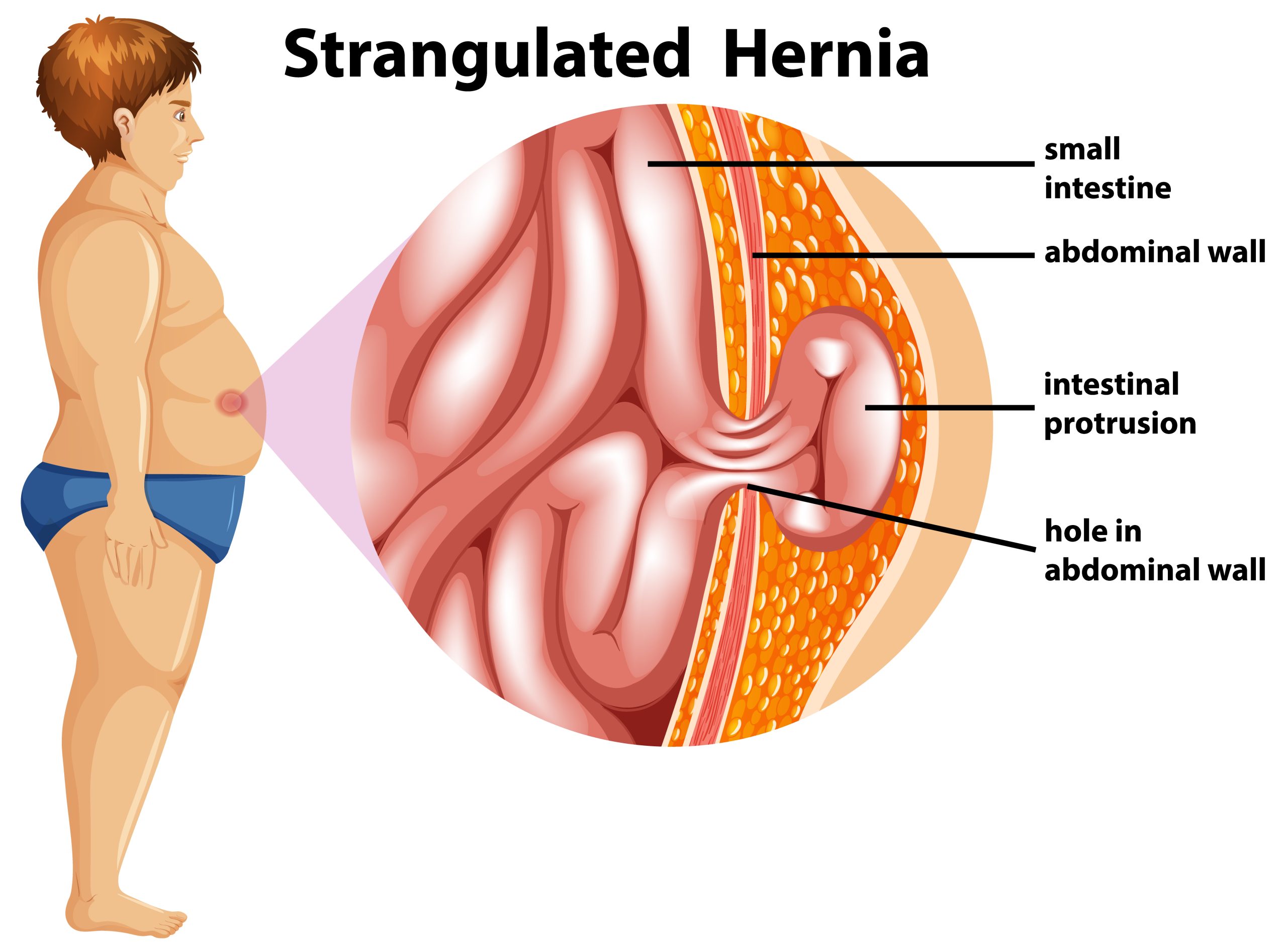 Lipoma specialist in Hyderabad