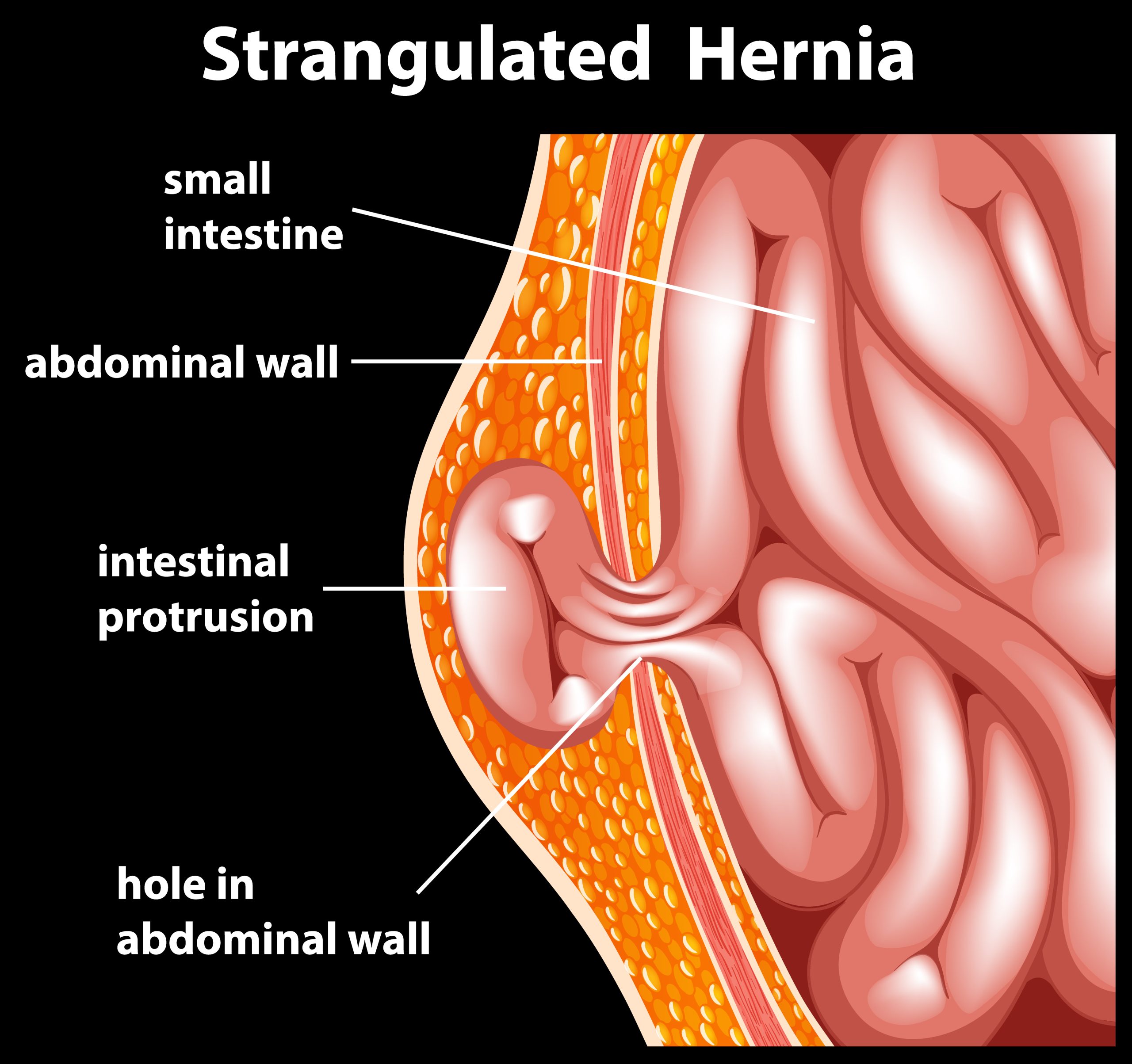 Comprehensive Lipoma Care: Choose the Best Lipoma Specialist in Hyderabad