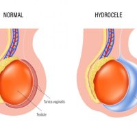 Hydrocele Specialist Near Me