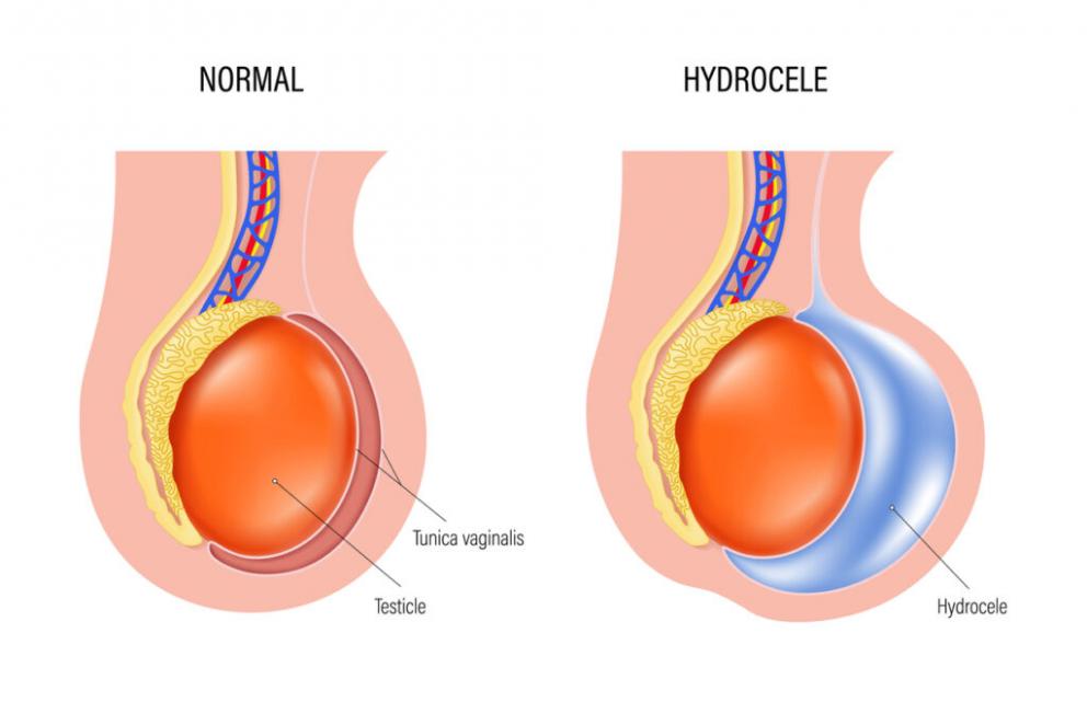 Expert Hydrocele Care: Top Hydrocele Specialist Near Me