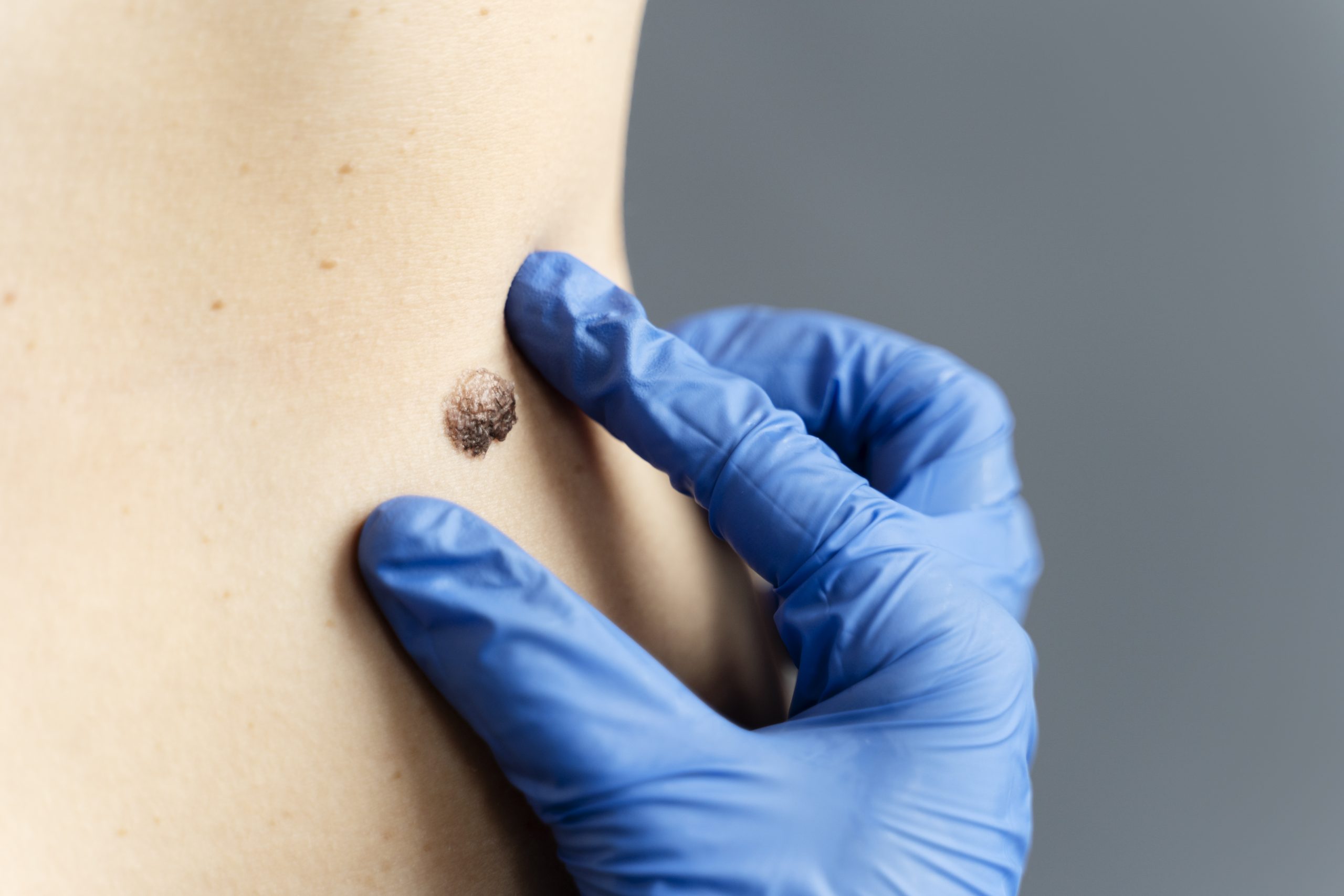 Lipoma specialist in Hyderabad