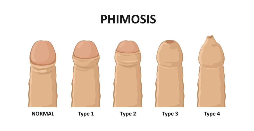 phimosis doctor in hyderabad