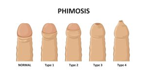 best phimosis doctor in hyderabad
