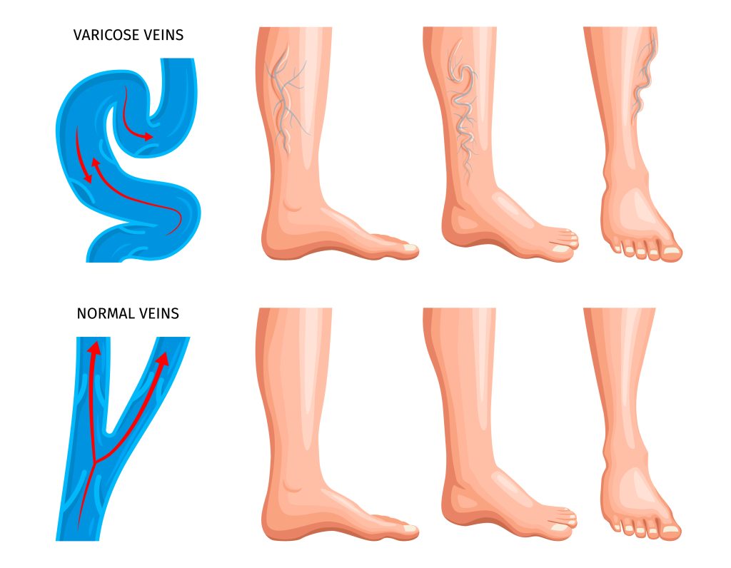 Navigating Varicose Veins Treatment: Best Varicose Doctor Near Me