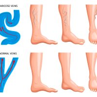 Varicose Veins Treatment