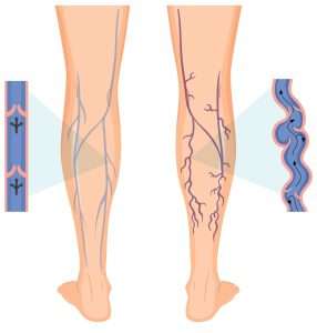 Varicose Veins Treatment