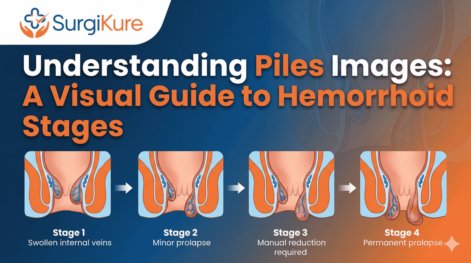 Piles Images What Hemorrhoids Look Like In Men Women Visual Guide 