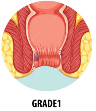 Diagram of Stage 1 internal piles images showing slight swelling inside the anal canal.