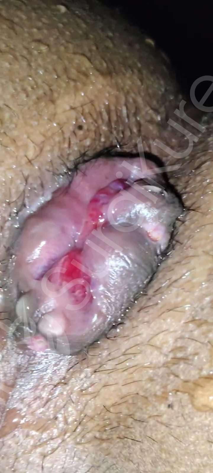 Diagram showing Grade 3 piles images where the prolapsed hemorrhoid requires manual pushing to return inside the anal canal.