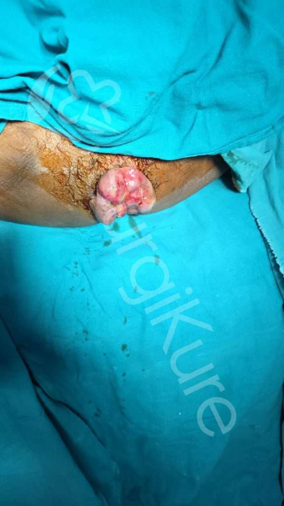 Clinical illustration of Grade 4 piles images displaying permanently prolapsed hemorrhoid tissue that cannot be pushed back in