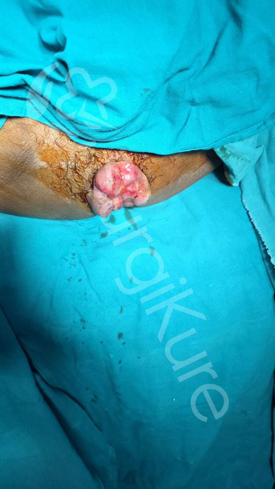 Clinical illustration of Grade 4 piles images displaying permanently prolapsed hemorrhoid tissue that cannot be pushed back in