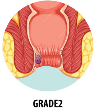 Piles images showing Stage 2 prolapse occurring during straining.